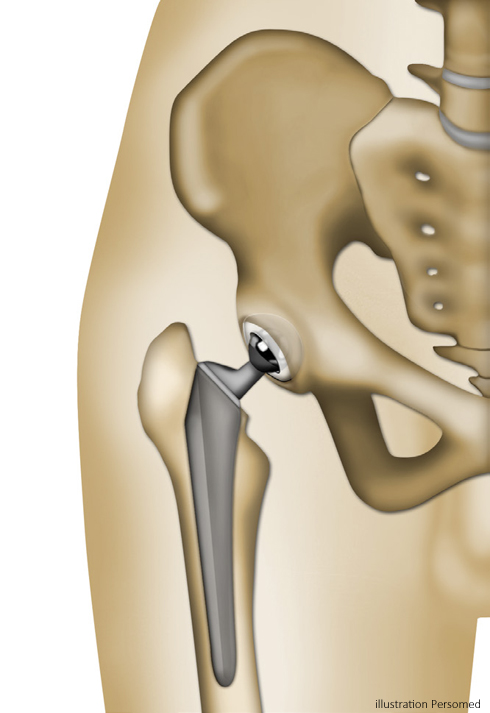 Résultat de recherche d'images pour "prothèse de hanche"