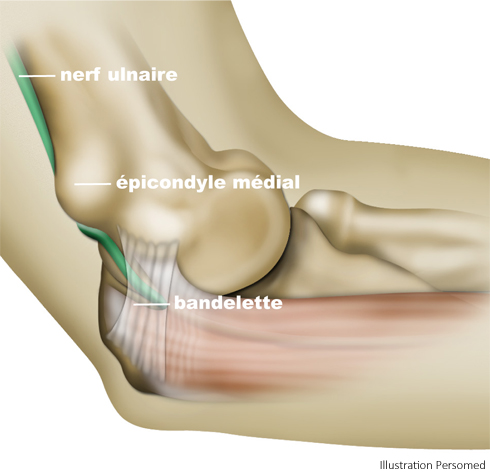 Ulnar nerve entrapment at the elbow (Cubital Tunnel Syndrome